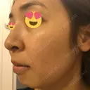 水光注射（ハリ・美肌） / ハイフ（顔） シロアム韓方美容・ダイエットクリニック(美&EYE) DAY 18 サムネイル用