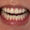 矯正（マウスピース） 湘南歯科クリニック 池袋院 DAY 59 サムネイル用