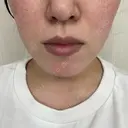 光治療（フォトフェイシャルなど） / ピーリング（ハリ・ツヤ） トラスト美容クリニック 銀座院 AFTER サムネイル用