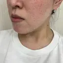 光治療（フォトフェイシャルなど） / ピーリング（ハリ・ツヤ） トラスト美容クリニック 銀座院 DAY 2 サムネイル用