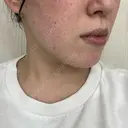 光治療（フォトフェイシャルなど） / ピーリング（ハリ・ツヤ） トラスト美容クリニック 銀座院 DAY 2 サムネイル用