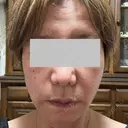 RF（高周波）たるみ治療 Wi Clinic （ウィ クリニック）心斎橋院 AFTER サムネイル用