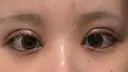 二重埋没 / 目頭切開 東京シンデレラ美容外科 池袋院 DAY 1 サムネイル用