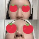 ヒアルロン酸注入（鼻） A CLINIC（エークリニック） 横浜院 DAY 1 サムネイル用