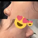 鼻尖形成（切開） / 小鼻縮小（切開） / 軟骨移植 ASTRA BEAUTY CLINIC DAY 20 サムネイル用