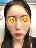 ピコレーザートーニング（美白・肝斑） シェリークリニック 渋谷院 AFTER サムネイル用