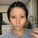 ボトックス（エラ・小顔） / ボトックス（肩） DMTC美容皮膚科 大宮院 AFTER サムネイル用