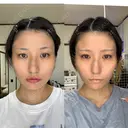 ボトックス（エラ・小顔） / ボトックス（肩） DMTC美容皮膚科 大宮院 DAY 65 サムネイル用