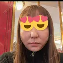 糸リフト BON BON CLINIC 銀座駅前本院 AFTER サムネイル用