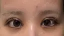 二重埋没 / 目頭切開 東京シンデレラ美容外科 池袋院 DAY 2 サムネイル用