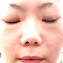 その他（輪郭） / ボトックス（眉間） TCB東京中央美容外科 福岡天神院 AFTER サムネイル用
