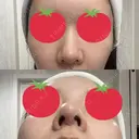 ヒアルロン酸注入（鼻） A CLINIC（エークリニック） 横浜院 DAY 2 サムネイル用