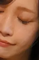 ヒアルロン酸注入（鼻） plume clinic AFTER サムネイル用