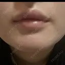 ボトックス（口角） / ボトックス（人中） DMTC CLINIC 日本橋院 DAY 6 サムネイル用