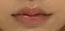 ヒアルロン酸注入（唇） プライベートスキンクリニック 梅田本院 DAY 0 サムネイル用