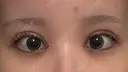 二重埋没 / 目頭切開 東京シンデレラ美容外科 池袋院 DAY 3 サムネイル用