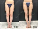 脂肪吸引（脚） 東京脂肪吸引クリニック DAY 204 サムネイル用