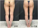 脂肪吸引（脚） 東京脂肪吸引クリニック DAY 204 サムネイル用