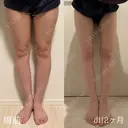 脂肪吸引（脚） 東京脂肪吸引クリニック AFTER サムネイル用