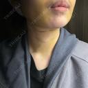 糸リフト / 脂肪吸引（顔） / ジョールファット除去 アリエル美容クリニック 横浜院 DAY 4 サムネイル用