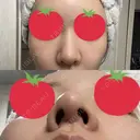 ヒアルロン酸注入（鼻） A CLINIC（エークリニック） 横浜院 DAY 4 サムネイル用