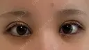 二重埋没 / 目頭切開 東京シンデレラ美容外科 池袋院 DAY 5 サムネイル用