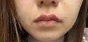 ヒアルロン酸注入（唇） 目白ホワイトクリニック DAY 0 サムネイル用