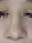 隆鼻術 / 鼻尖形成（切開） / 鼻中隔延長（切開） / その他（輪郭） リッツ美容外科 東京院 AFTER サムネイル用