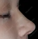 隆鼻術 / 鼻尖形成（切開） / 鼻中隔延長（切開） / その他（輪郭） リッツ美容外科 東京院 DAY 14 サムネイル用