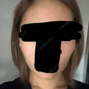 ボトックス（エラ・小顔） 札幌TAクリニック DAY 4 サムネイル用