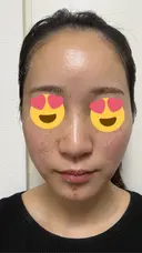 ピコレーザートーニング（美白・肝斑） / ピコフラクショナルレーザー（毛穴・ニキビ跡） / ピコスポット 東京シルククリニック 東京神田院 DAY 1 サムネイル用