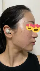 ピコレーザートーニング（美白・肝斑） / ピコフラクショナルレーザー（毛穴・ニキビ跡） / ピコスポット 東京シルククリニック 東京神田院 DAY 1 サムネイル用