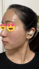 ピコレーザートーニング（美白・肝斑） / ピコフラクショナルレーザー（毛穴・ニキビ跡） / ピコスポット 東京シルククリニック 東京神田院 DAY 1 サムネイル用