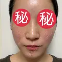 ピコレーザートーニング（美白・肝斑） / ピコフラクショナルレーザー（毛穴・ニキビ跡） / ピコスポット 東京シルククリニック 東京神田院 DAY 2 サムネイル用