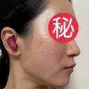 ピコレーザートーニング（美白・肝斑） / ピコフラクショナルレーザー（毛穴・ニキビ跡） / ピコスポット 東京シルククリニック 東京神田院 DAY 2 サムネイル用