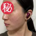 ピコレーザートーニング（美白・肝斑） / ピコフラクショナルレーザー（毛穴・ニキビ跡） / ピコスポット 東京シルククリニック 東京神田院 DAY 2 サムネイル用