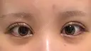二重埋没 / 目頭切開 東京シンデレラ美容外科 池袋院 DAY 6 サムネイル用