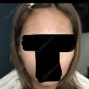 ボトックス（エラ・小顔） 札幌TAクリニック DAY 5 サムネイル用