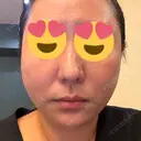 糸リフト BON BON CLINIC 銀座駅前本院 DAY 1 サムネイル用