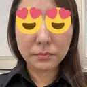 糸リフト BON BON CLINIC 銀座駅前本院 DAY 4 サムネイル用