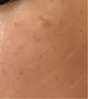 ルメッカ Clinic K Blossom DAY 1 サムネイル用