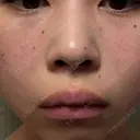 ルメッカ ルラ美容クリニック 大宮院 / ルラスキンクリニック 大宮院 DAY 8 サムネイル用