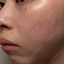 ルメッカ ルラ美容クリニック 大宮院 / ルラスキンクリニック 大宮院 DAY 8 サムネイル用