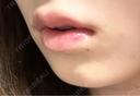ヒアルロン酸注入（唇） / ボトックス（口角） ルラ美容クリニック 仙台院 / ルラスキンクリニック 仙台院 DAY 1 サムネイル用