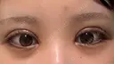 二重埋没 / 目頭切開 東京シンデレラ美容外科 池袋院 DAY 7 サムネイル用