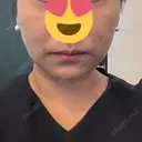 糸リフト / 脂肪吸引注射（顔） 新宿美容外科ネビュラクリニック DAY 15 サムネイル用