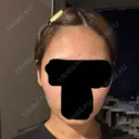 ボトックス（エラ・小顔） 札幌TAクリニック DAY 6 サムネイル用