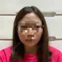 糸リフト / 脂肪吸引（顔） / ジョールファット除去 GRACIA clinic 【グラシアクリニック】 DAY 2 サムネイル用