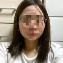 糸リフト / 脂肪吸引（顔） / ジョールファット除去 GRACIA clinic 【グラシアクリニック】 DAY 3 サムネイル用