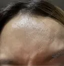 ボトックス（あご） / ボトックス（眉間） / ボトックス（目尻） / ボトックス（額） TCB東京中央美容外科 名古屋栄院 DAY 1 サムネイル用